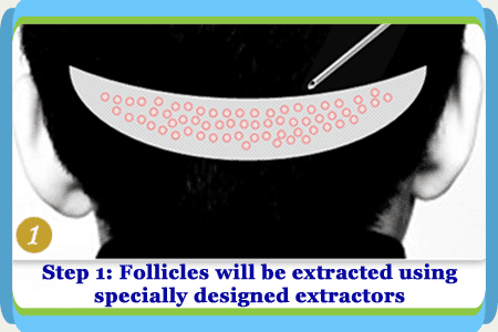 Follicular Unit Extraction Step 1 in China